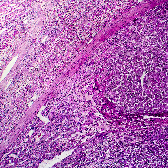 The Role of Oncology Nurse Navigators in Hepatocellular Carcinoma Treatment