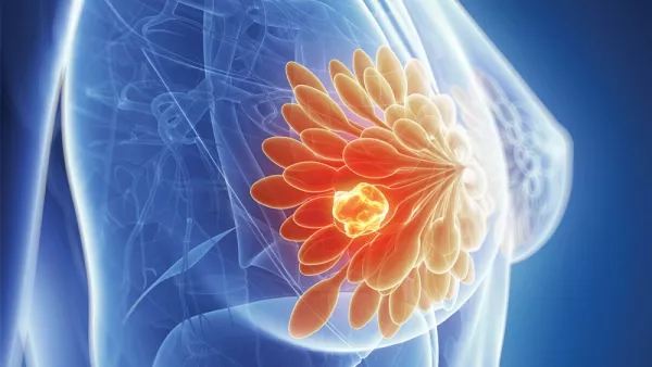 3D illustration of breast tumor