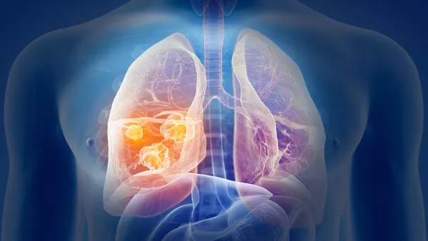 3D illustration of lung tumors